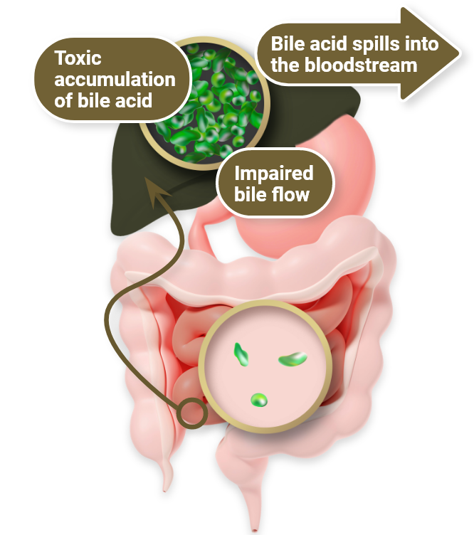 Arrows show the way bile acids spill into the bloodstream, impairing the flow, and building up in toxic amounts in a liver with Bylvay  (134)